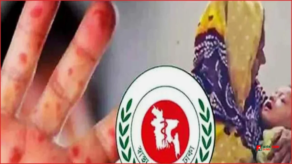 সিলেটে হামের উপসর্গে আরও ২ শিশুর মৃত্যু, মোট প্রাণহানি ১৬৮