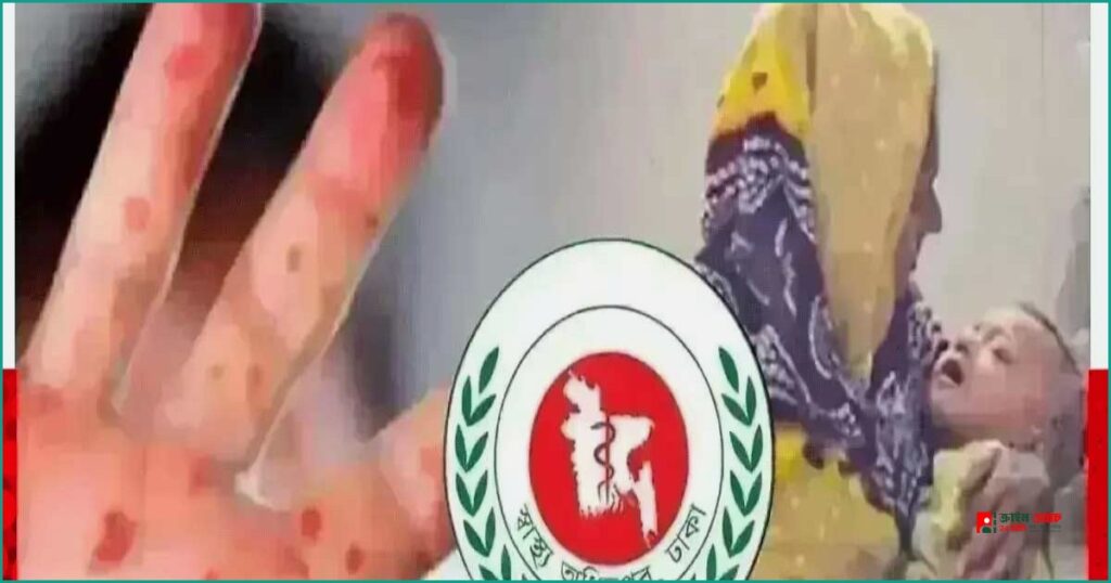 হাম ও উপসর্গে দেশে মৃতের সংখ্যা ছাড়াল এক হাজার