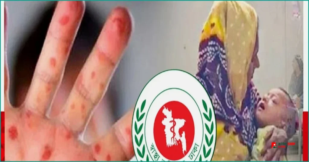 দেশে হাম ও উপসর্গে আরও ৫ শিশুর মৃত্যু, মোট প্রাণহানি ১২০১